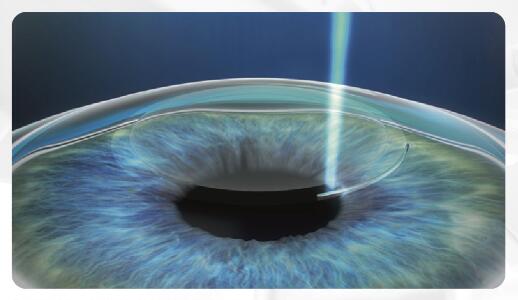 全飛秒近視手術