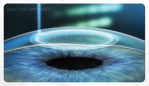 全飛秒激光近視手術