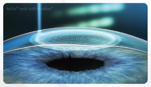 近視手術注意事項