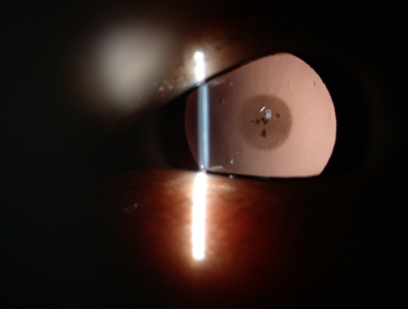 白內(nèi)障癥狀