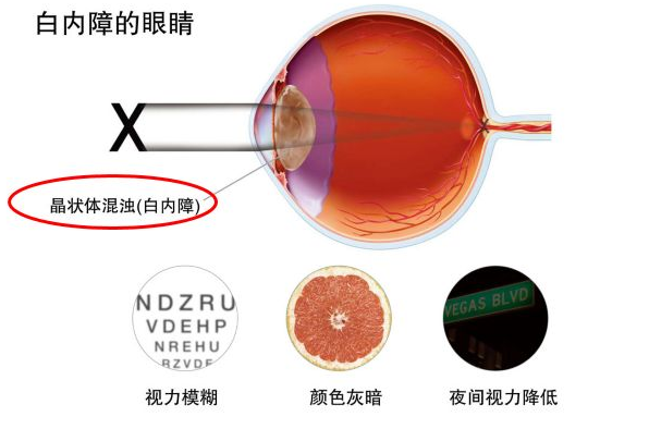 白內(nèi)障癥狀